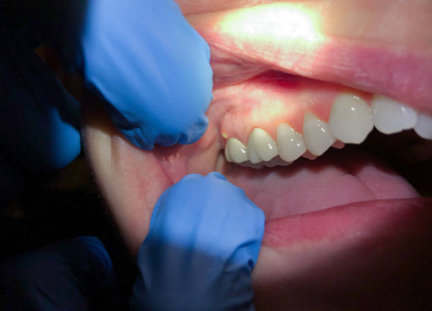 Best Emergency Wisdom Teeth Removal in Buckeystown, MD